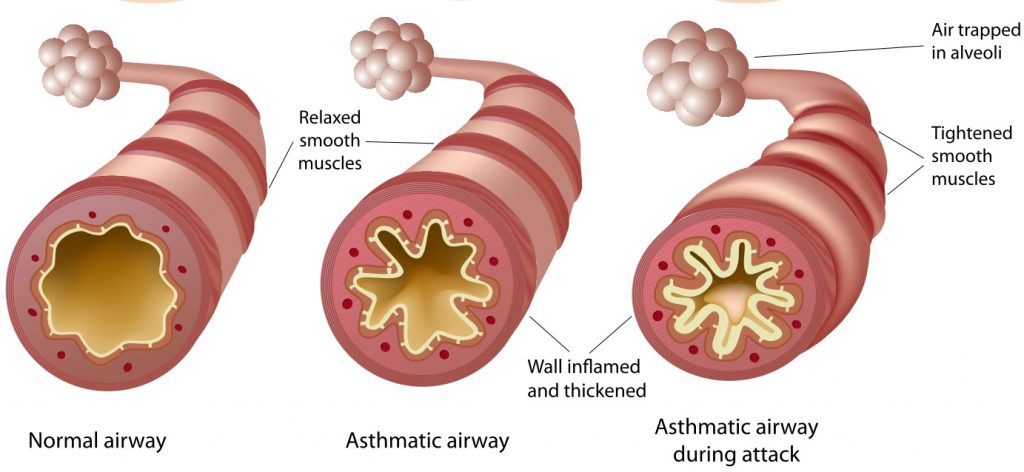 Image of your airway being inflamed and thickened due to asthma.